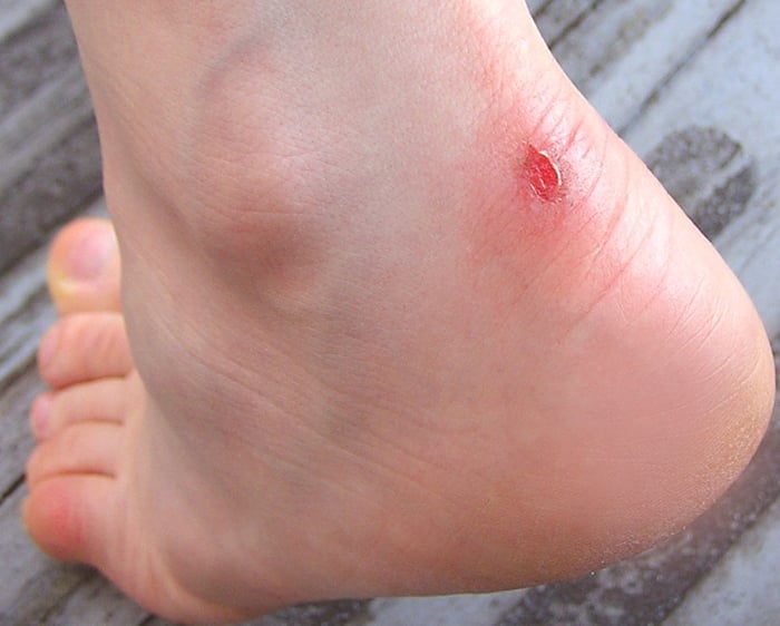 Shoe Pavilion - Blisters quickly form. This blister is three days old