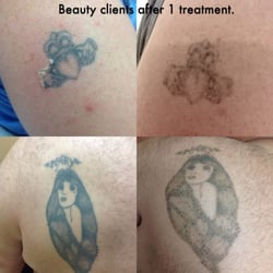 Tattoo Removal by Dawn M.