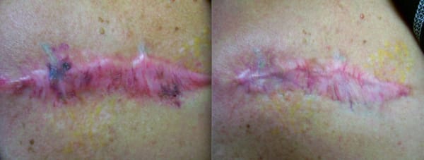 Actual Patient: Scar Rejuvenation using Medlite C6 and ...