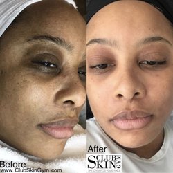 Oxygen facial in orange county ca picture 71