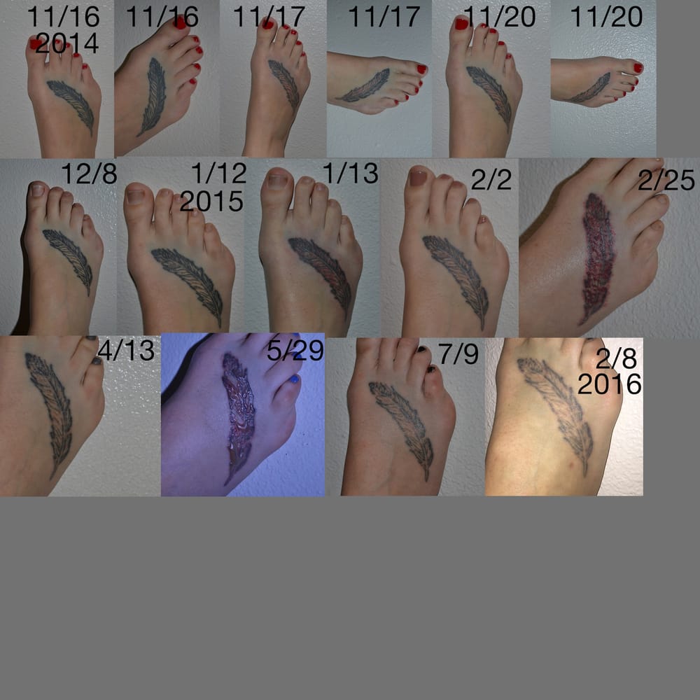 foot tattoo 8 sessions tattoo removal progress from 11 2014 2 foot tattoo 8 sessions tattoo removal progress from 11 2014 2