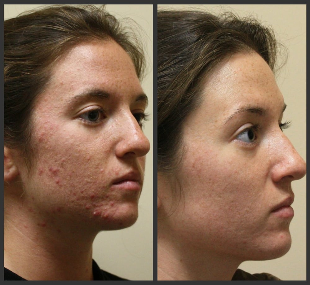 Isolaz And Fraxel Acne Laser Treatments Before After Yelp