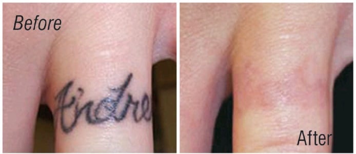 Photo Of Inked No More Tattoo Removal Tampa Fl United States Hypertonic Photo Of Inked No More Tattoo Removal Tampa Fl United States Hypertonic