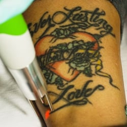 baltimore tattoo removal 11 photos tattoo removal 9515 baltimore tattoo removal 11 photos tattoo removal 9515