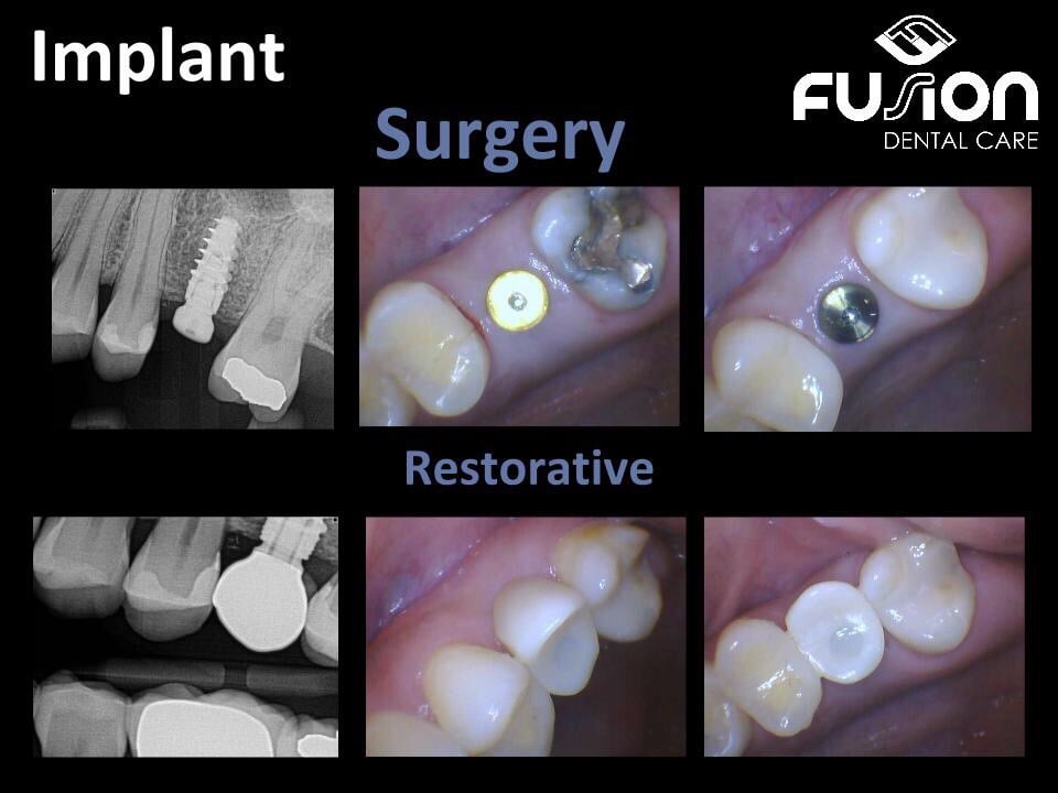 dental implants from dentist in Raleigh, NC