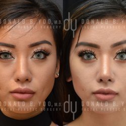 Rhinoplasty before and after pictures asian dresses Rhinoplasty before and after pictures asian dresses