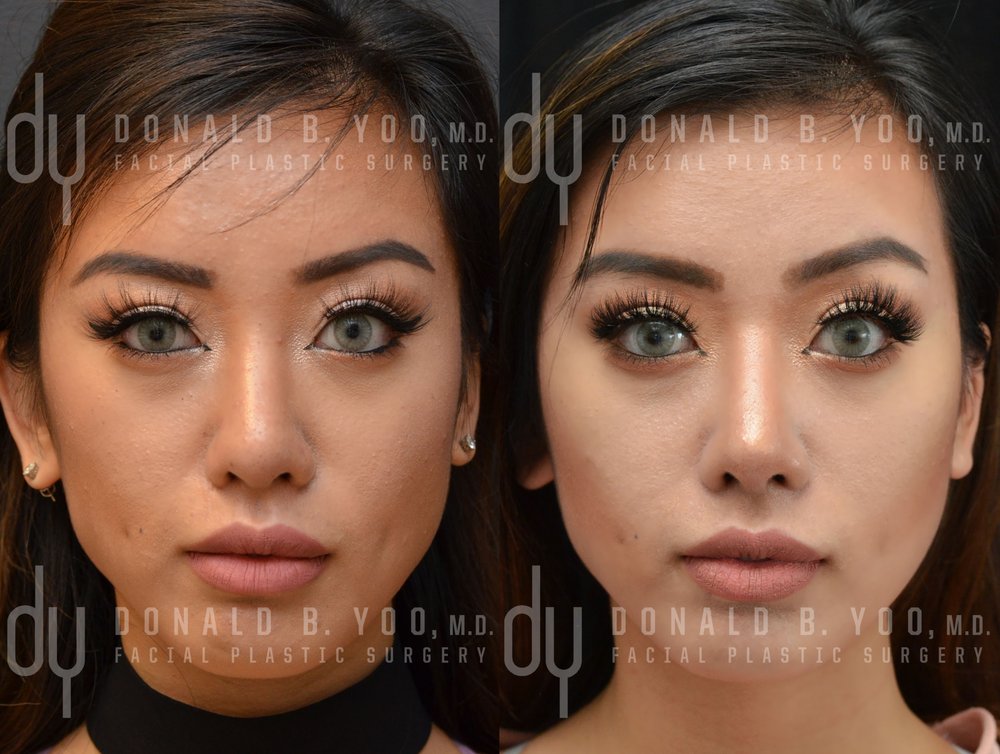 Before and After Revision Asian Rhinoplasty with rib