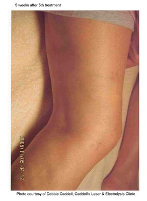 Do you lose weight by just walking photo 4