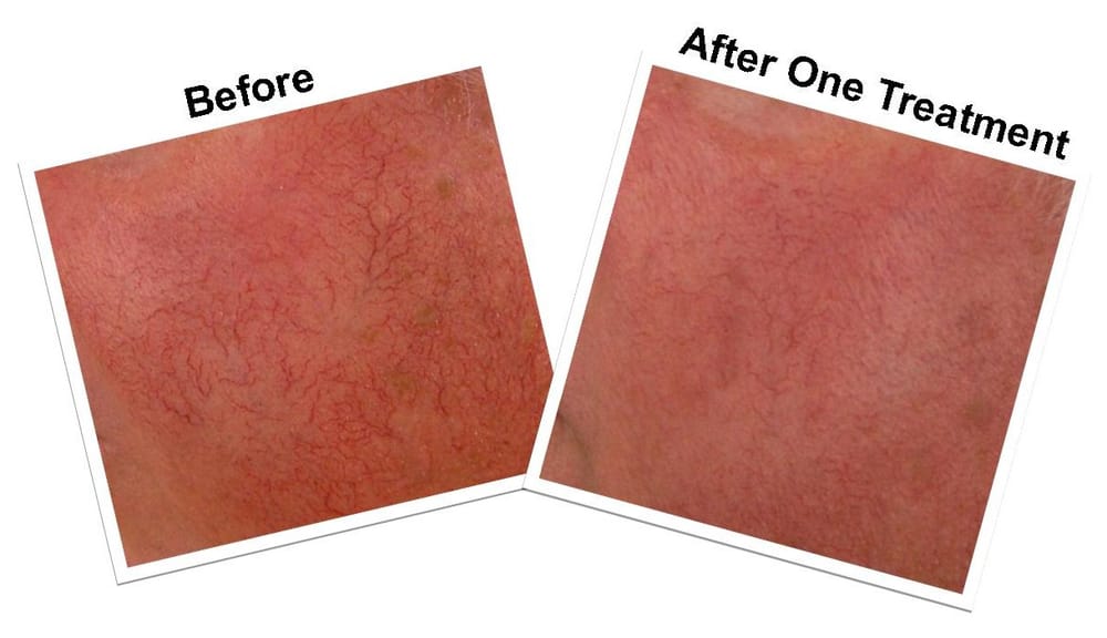 Laser Institute Of Newport Beach Laser Institute Of Newport Beach