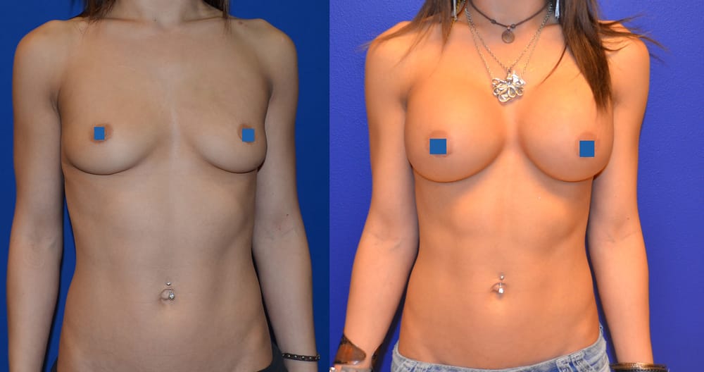 brigidas free big boob galleries breast implants in bel air maryland
