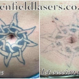 glenfield lasers 25 photos tattoo removal 7 pymm ley close glenfield lasers 25 photos tattoo removal 7 pymm ley close