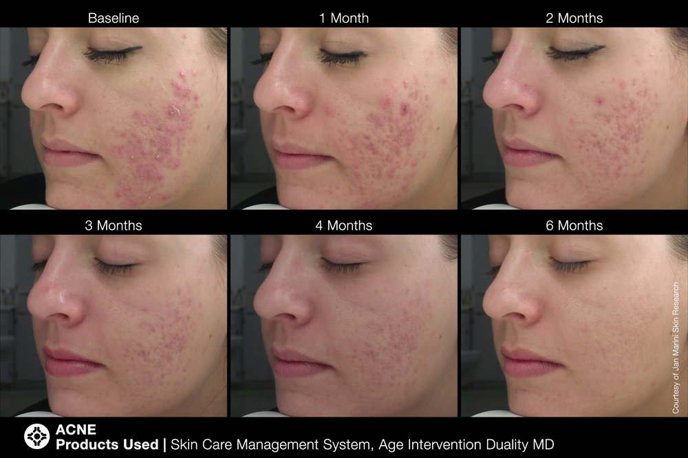 jan marini acne jan marini acne