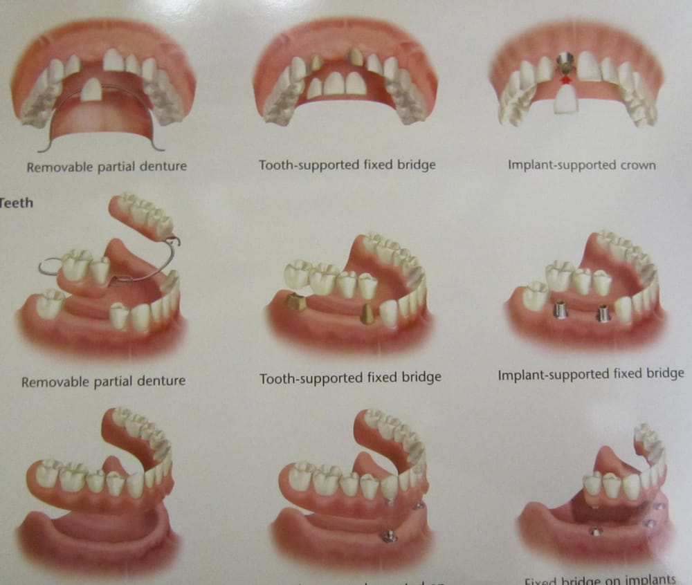 Options for replacing missing teeth yelp