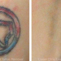 eraser clinic laser tattoo removal 81 photos u0026 21 reviews eraser clinic laser tattoo removal 81 photos u0026 21 reviews