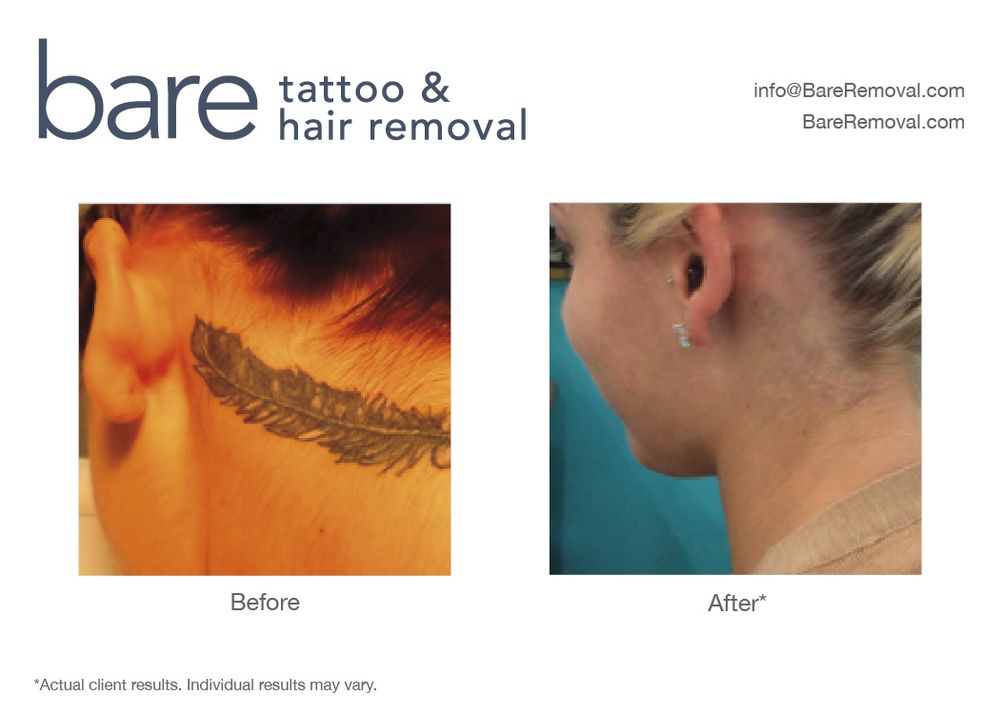 bare tattoo u0026 hair removal tattoo removal 9339 calumet ave bare tattoo u0026 hair removal tattoo removal 9339 calumet ave
