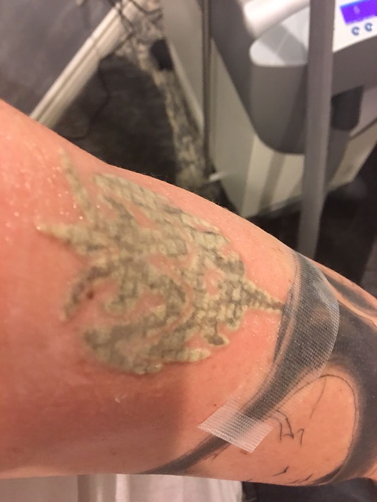 phaze laser med spa closed tattoo removal 9420 w phaze laser med spa closed tattoo removal 9420 w