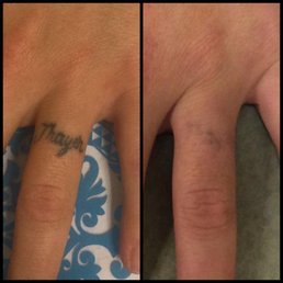Photo Of Absolute Laser Tattoo Removal Hermosa Beach Ca United States Photo Of Absolute Laser Tattoo Removal Hermosa Beach Ca United States