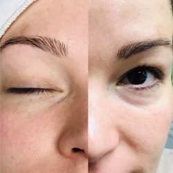 2000 epil facial hair removal uk photo