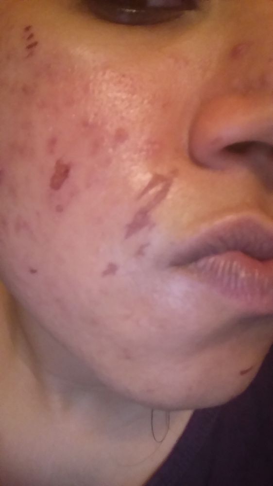 facial waxing burn Facial waxing burn