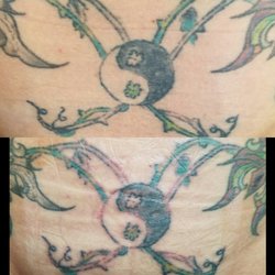 sound tattoo removal tattoo removal 32014 32nd ave s federal sound tattoo removal tattoo removal 32014 32nd ave s federal