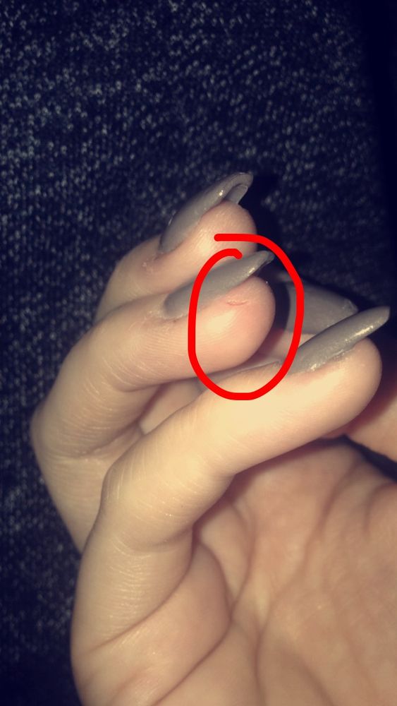 Burn Cut On Side Of Finger From Nail File That Got Extremely Warm Photo Of Red Persimmon Nails Watertown Ma United States Burn Cut