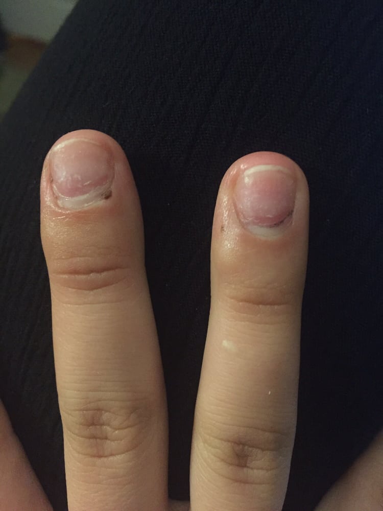 Dried Blood Under The Nail Pink Is Burned Area Also Got My Photo Of Natural Nails Ann Arbor Mi United States Dried Blood Under