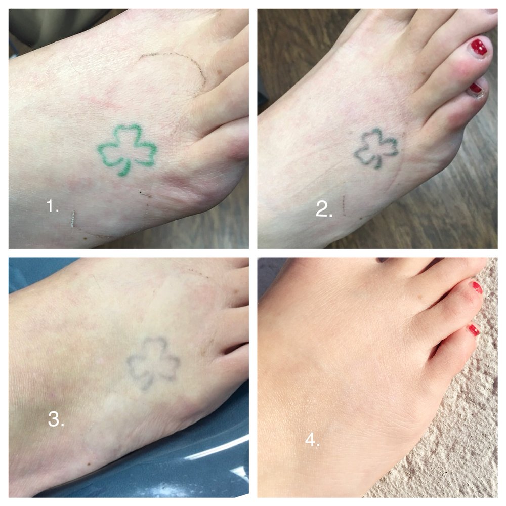 Photo Of Erasable Inc Tampa Fl United States Laser Tattoo Removal Photo Of Erasable Inc Tampa Fl United States Laser Tattoo Removal