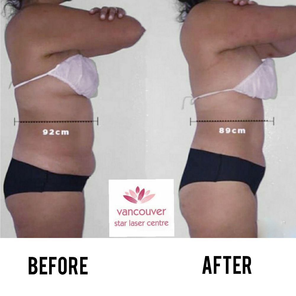 Vancouver Star Laser Centre