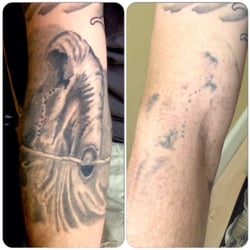 way gone laser tattoo removal 121 photos u0026 76 reviews tattoo way gone laser tattoo removal 121 photos u0026 76 reviews tattoo