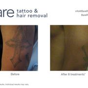 bare tattoo u0026 hair removal tattoo removal 9339 calumet ave bare tattoo u0026 hair removal tattoo removal 9339 calumet ave