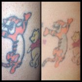 erased laser tattoo removal 65 photos u0026 57 reviews tattoo erased laser tattoo removal 65 photos u0026 57 reviews tattoo