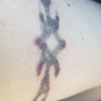erased laser tattoo removal 65 photos u0026 57 reviews tattoo erased laser tattoo removal 65 photos u0026 57 reviews tattoo