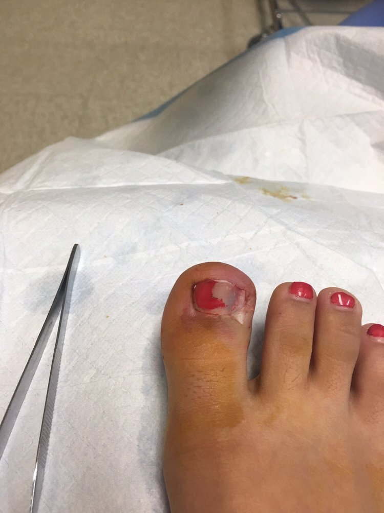 Ingrown Toe Nail Due To Incorrect Cutting Infection From Not Using Photo Of T Nail Spa Visalia Ca United States Ingrown Toe