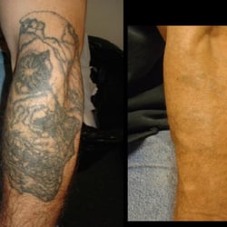 project erase tattoo removal tattoo removal 1719 w burnside st project erase tattoo removal tattoo removal 1719 w burnside st