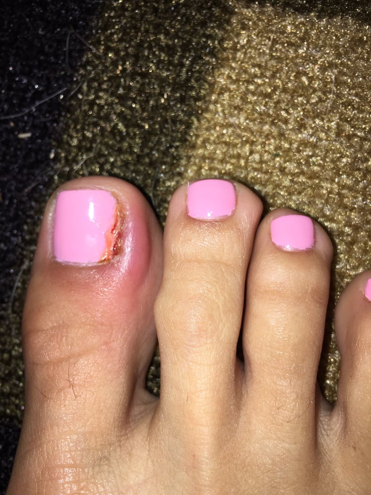 Got A Pedicure Yesterday And Made Hangnail Ripped It Out Photo Of Tulip Nails Inglewood Ca United States Got A Pedicure Yesterday