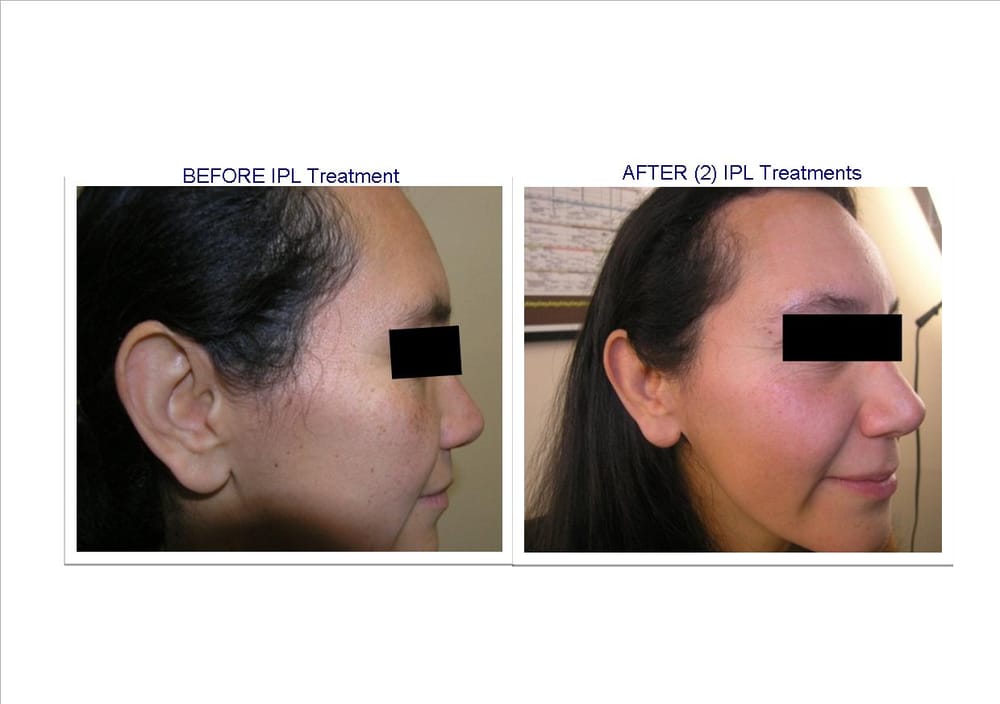 Laser Institute Of Newport Beach Laser Institute Of Newport Beach