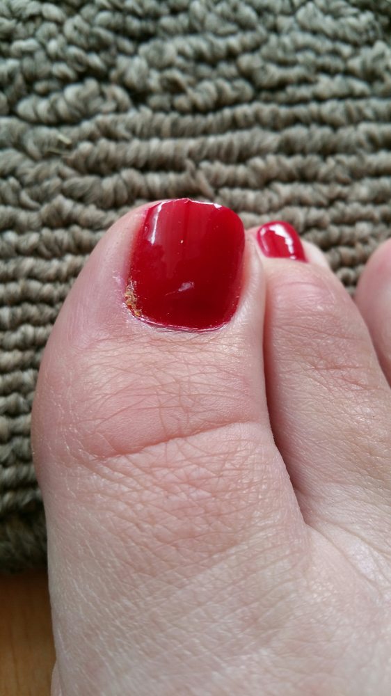 Small Infection On Toe After Pedicurist Pulled A Hang Nail Photo Of Pearl Nails Rosemead Ca United States Small Infection On