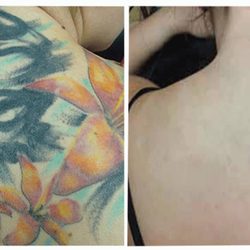 Clearskin Laser Hair Removal 13 Coast Road Newcastle Upon