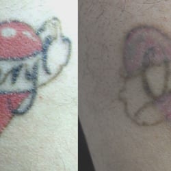 tattoo removal canada closed 19 photos tattoo removal 4300 tattoo removal canada closed 19 photos tattoo removal 4300