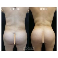 fat transfer breast augmentation marylan Cold sore oral sex