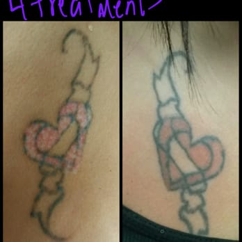 erased laser tattoo removal 65 photos u0026 57 reviews tattoo erased laser tattoo removal 65 photos u0026 57 reviews tattoo