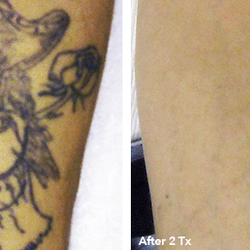 st pete tattoo removal tattoo removal 8130 66th st n pinellas st pete tattoo removal tattoo removal 8130 66th st n pinellas