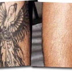 Photo Of Palm Beach Tattoo Removal Wellington Fl United States Photo Of Palm Beach Tattoo Removal Wellington Fl United States