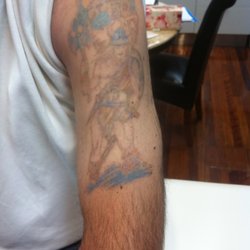 medilase laser tattoo removal specialists 19 photos tattoo medilase laser tattoo removal specialists 19 photos tattoo