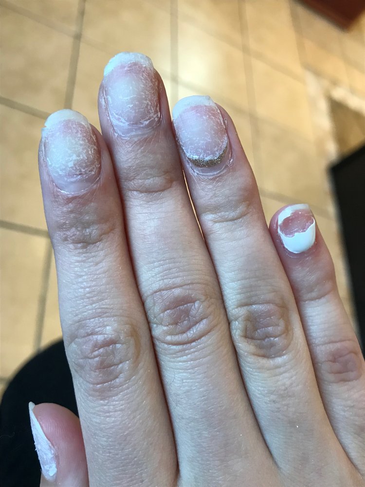 Aftermath Of The Nail Tech Ripping Off My Acrylic Nails Using A Fake Photo Of Gorgeous Nail Spa Hillsboro Or United States Aftermath