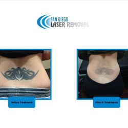san diego laser tattoo removal 66 photos u0026 53 reviews tattoo san diego laser tattoo removal 66 photos u0026 53 reviews tattoo