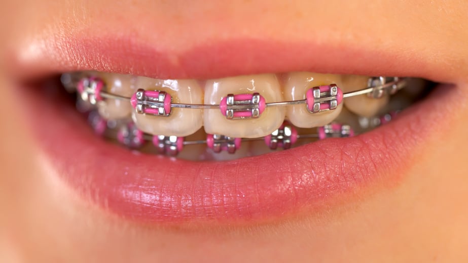 Photos for The Best Braces Yelp