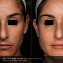 phoenix tattoo removal and skin revitalization 20 photos u0026 13 phoenix tattoo removal and skin revitalization 20 photos u0026 13