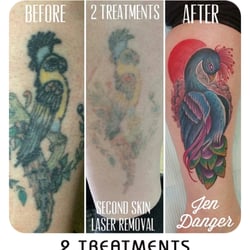 second skin tattoo removal 10 photos skin care 10502 107 second skin tattoo removal 10 photos skin care 10502 107