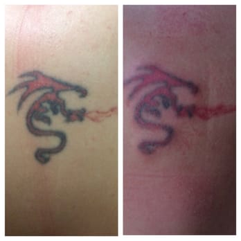 invisible tattoo ink removers treatment before louis park excelsior removal